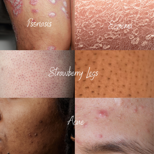 The Golden glow set (Eczema, Psoriasis, Acne, Dry Skin, Strawberry Legs)
