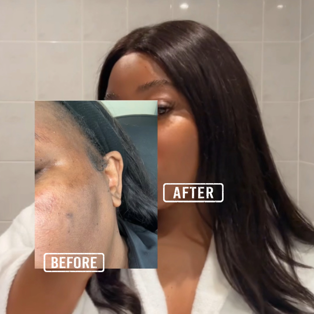 HyperP Serum